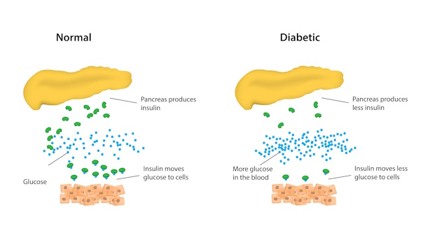 Diabetes type-2 onder controle | Leefstijl als medicijn